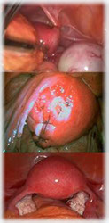 collage laparoscopia